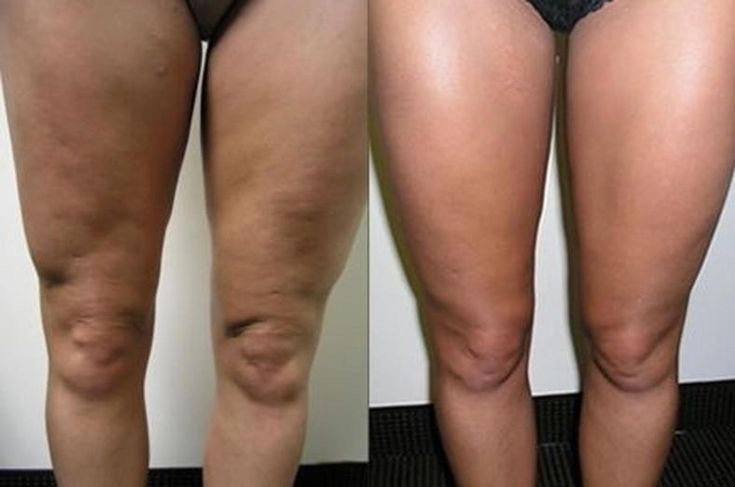 Beautylizer RSL: фотопротокол до и после