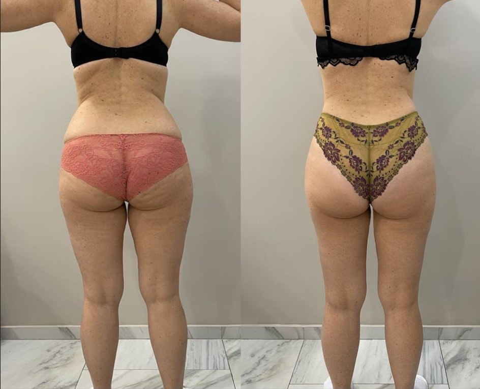 Icoone laser: фотопротокол до и после